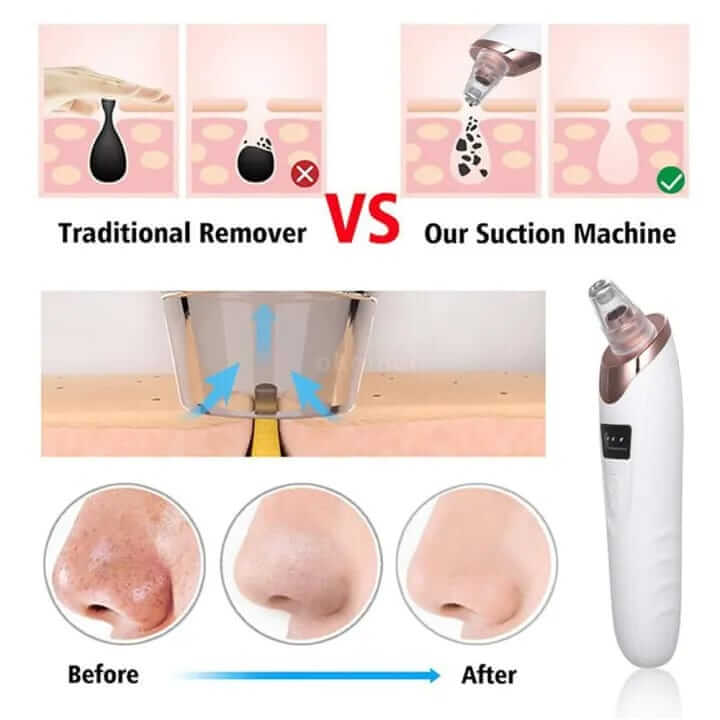 USB Rechargeable Blackhead Remover